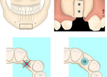 tratamiento dental injertos oseos